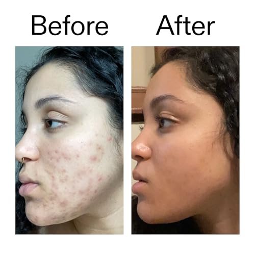 The INKEY List Tranexamic Acid Serum – Reduce Dark Spots & Uneven Skin Tone, 1 fl oz Avelisse