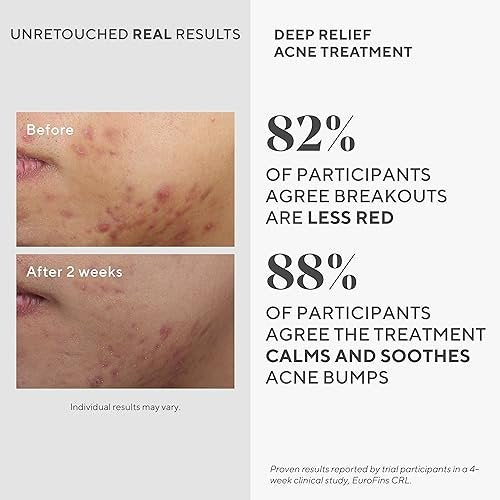 Murad Deep Relief Acne Spot Treatment with 2% Salicylic Acid – Patch-Like Liquid Treatment for Deep, Hormonal Acne & Breakouts – 1 Fl Oz Avelisse