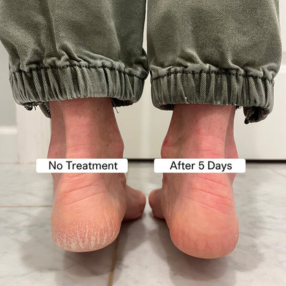 Pedestrian Project Cracked Heel Repair Foot Care Balm – Smooths & Fills Cracks with Shea & Mango Butters, Vegan & Cruelty Free, 1 oz Avelisse