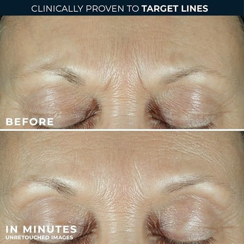 RoC Derm Correxion Fill + Treat Advanced Retinol Serum with Hyaluronic Acid for Crow's Feet, 11 Wrinkles & Laugh Lines, 0.5 fl oz Avelisse
