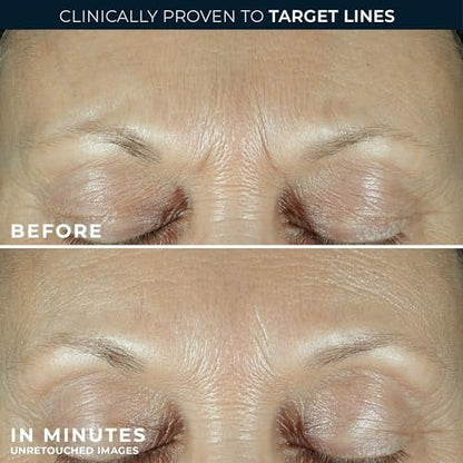 RoC Derm Correxion Fill + Treat Advanced Retinol Serum with Hyaluronic Acid for Crow's Feet, 11 Wrinkles & Laugh Lines, 0.5 fl oz Avelisse