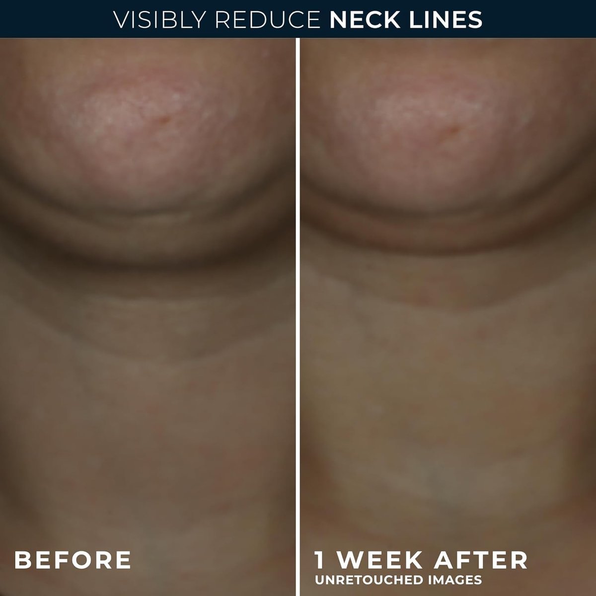 RoC Derm Correxion Neck Cream with Hyaluronic Acid + Advanced Retinol - Visibly Tighten & Lift Horizontal Neck Lines, 1.7 oz Avelisse