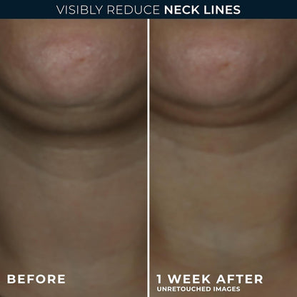 RoC Derm Correxion Neck Cream with Hyaluronic Acid + Advanced Retinol - Visibly Tighten & Lift Horizontal Neck Lines, 1.7 oz Avelisse