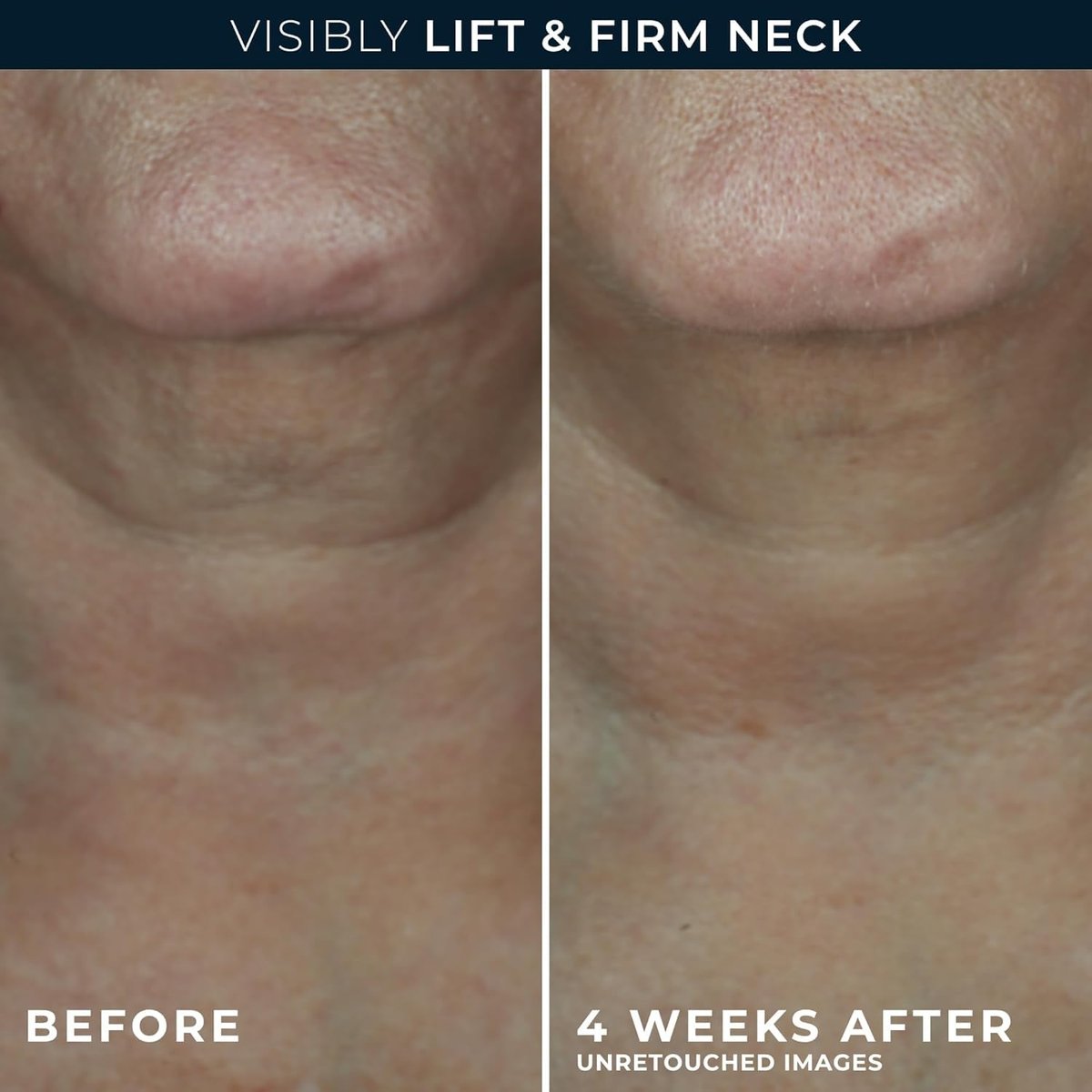 RoC Derm Correxion Neck Cream with Hyaluronic Acid + Advanced Retinol - Visibly Tighten & Lift Horizontal Neck Lines, 1.7 oz Avelisse
