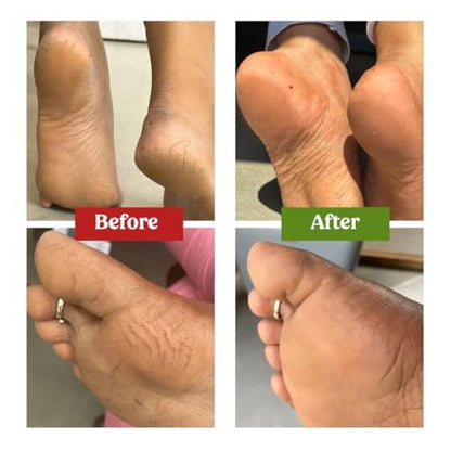 Vilvah Foot Cream for Dry and Cracked Feet | Moisturizes Rough Heels, Softens Chapped & Calloused Skin – Suitable for All Skin Types, 100ml