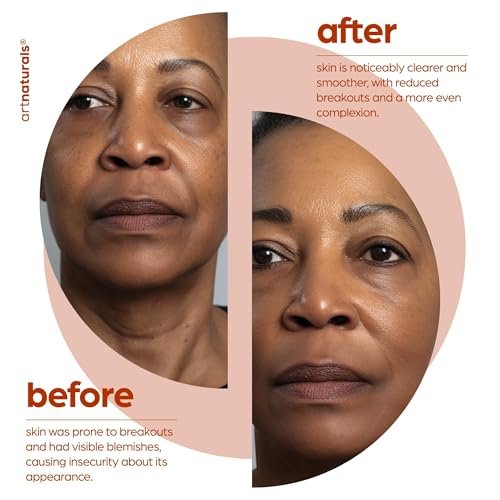 Artnaturals Salicylic Acid Serum – 2% BHA Acne Treatment & Pore Reducer, 1 oz Avelisse