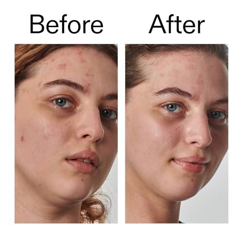 The INKEY List SuperSolutions Urea 10% Moisturizer – Hydrate, Nourish & Soothe Dry Skin with Gentle Exfoliation Avelisse