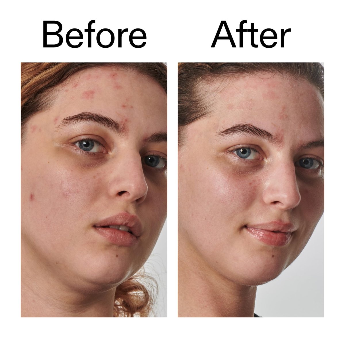 The INKEY List SuperSolutions Urea 10% Moisturizer – Hydrate, Nourish & Soothe Dry Skin with Gentle Exfoliation Avelisse