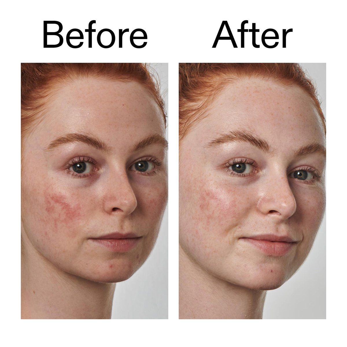 The INKEY List SuperSolutions Azelaic Acid 10% Serum – Reduce Redness & Soothe Sensitive Skin, Fast-Absorbing, No White Cast, 1.01 oz - görsel 13