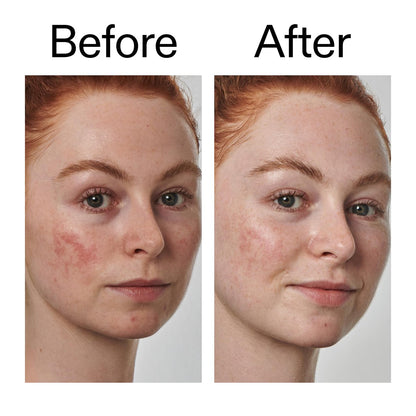 The INKEY List SuperSolutions Azelaic Acid 10% Serum – Reduce Redness & Soothe Sensitive Skin, Fast-Absorbing, No White Cast, 1.01 oz