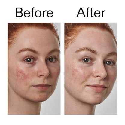 The INKEY List SuperSolutions Azelaic Acid 10% Serum – Reduce Redness & Soothe Sensitive Skin, Fast-Absorbing, No White Cast, 1.01 oz