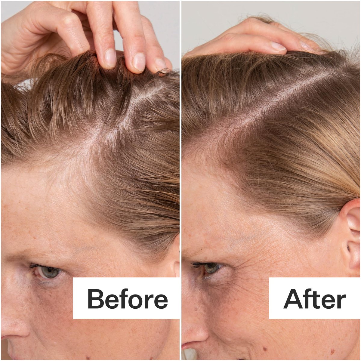Act+ Acre Cold Processed Salicylic Acid Scalp Exfoliator – 2 Fl Oz Avelisse