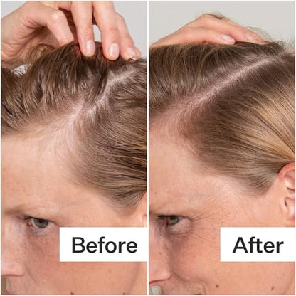 Act+ Acre Cold Processed Salicylic Acid Scalp Exfoliator – 2 Fl Oz Avelisse