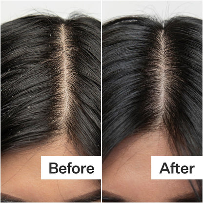 Act+ Acre Cold Processed Salicylic Acid Scalp Exfoliator – 2 Fl Oz Avelisse