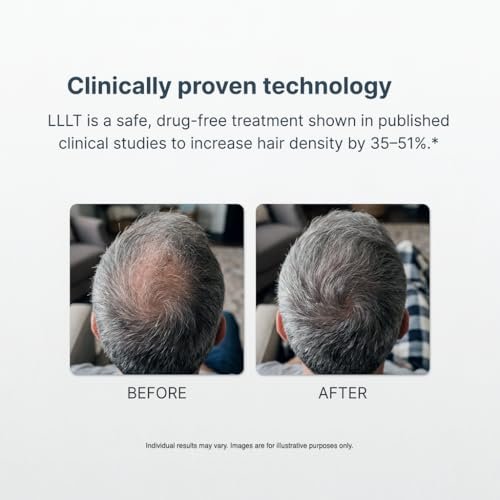 Xtrallux Alpha Hair Growth Laser Cap - FDA Cleared 136 Lasers for Men & Women, SMT Technology, 6-Min Daily Treatment - görsel 6