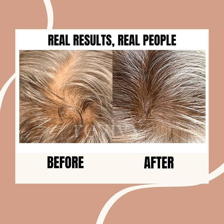 REVIVV Roller for Hair Rejuvenation – 0.25mm Microneedling Derma Roller for Scalp, Beard, and Skin – 45-Day Supply - görsel 10