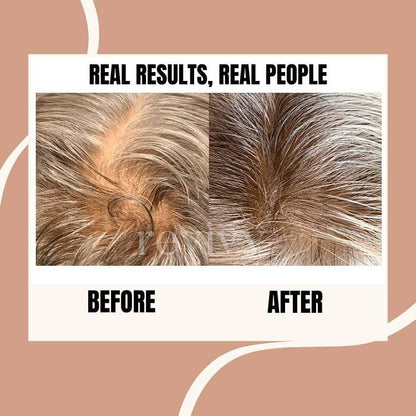 REVIVV Roller for Hair Rejuvenation – 0.25mm Microneedling Derma Roller for Scalp, Beard, and Skin – 45-Day Supply