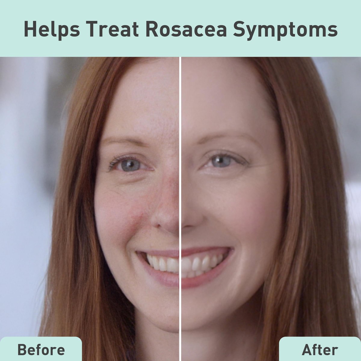 PROcure Rosacare Face Serum – Hyaluronic Acid, Niacinamide & Licorice Root for Redness Relief, Hydration & Sensitive Skin (1.08 fl oz) Avelisse