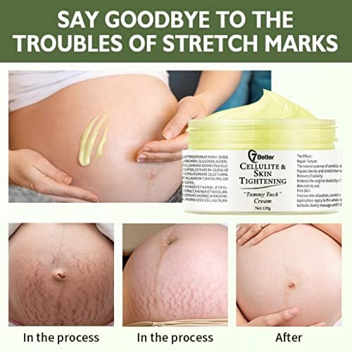 Stretch Marks & Scars Removal Cream for Pregnancy – Gentle Abdominal Firming & Scar Repair Skincare Avelisse