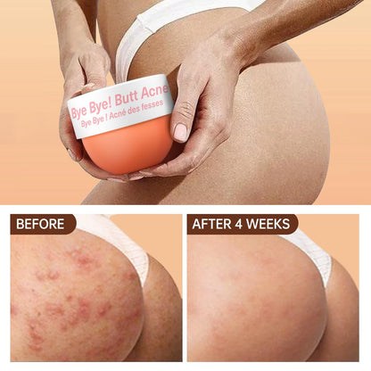 Butt Acne Clearing Treatment - Body Cream for Back, Buttocks, Thigh & Chest Acne - Skin Clearing Lotion for Men & Women - 5.46 oz Avelisse