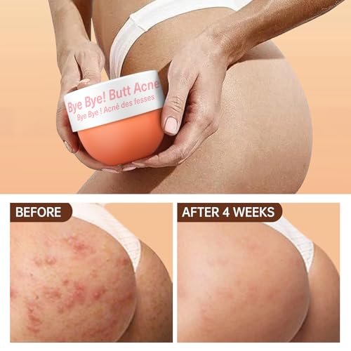 Butt Acne Clearing Treatment - Body Cream for Back, Buttocks, Thigh & Chest Acne - Skin Clearing Lotion for Men & Women - 5.46 oz Avelisse