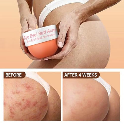 Butt Acne Clearing Treatment - Body Cream for Back, Buttocks, Thigh & Chest Acne - Skin Clearing Lotion for Men & Women - 5.46 oz Avelisse