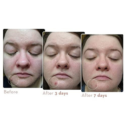 Sonage Zitlox Salicylic Acne Gel – Spot Treatment with Tea Tree Oil for Clear Skin