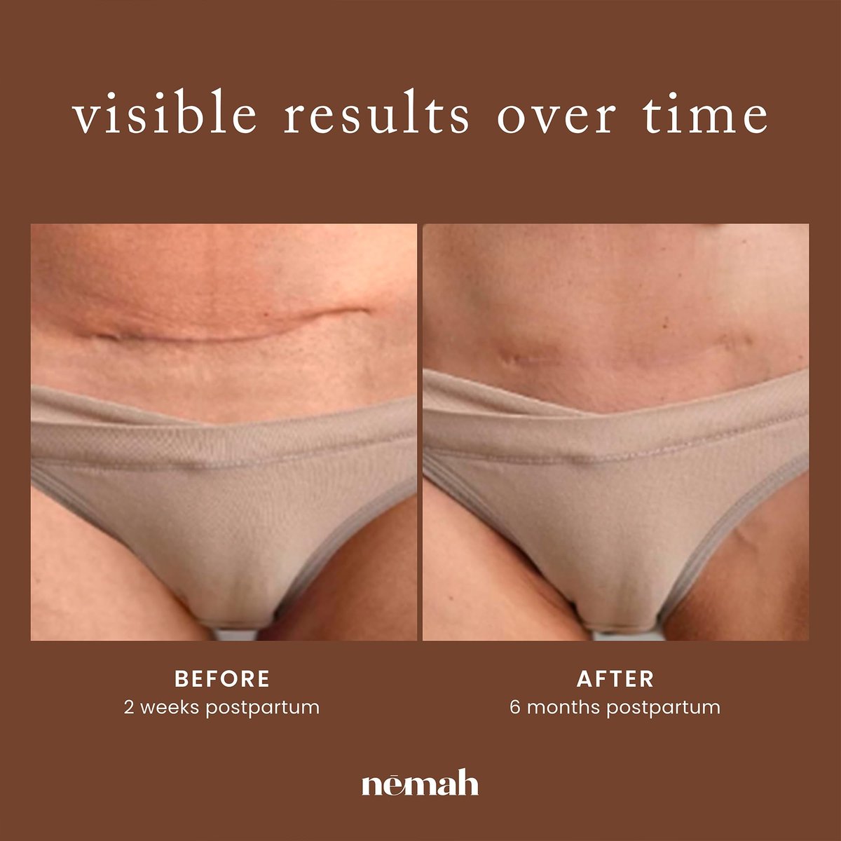Nemah Restorative Scar Treatment – C-Section Recovery Cream for Surgical Scars, Acne Marks, Dermatologist Approved, Antioxidant Rich Vegan Formula, 1 oz Avelisse