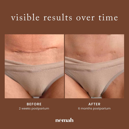 Nemah Restorative Scar Treatment – C-Section Recovery Cream for Surgical Scars, Acne Marks, Dermatologist Approved, Antioxidant Rich Vegan Formula, 1 oz Avelisse