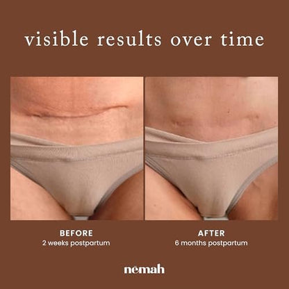 Nemah Restorative Scar Treatment – C-Section Recovery Cream for Surgical Scars, Acne Marks, Dermatologist Approved, Antioxidant Rich Vegan Formula, 1 oz Avelisse