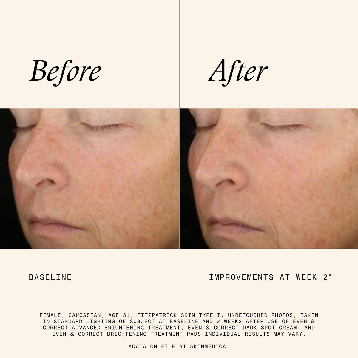SkinMedica Even & Correct Brightening Treatment Pads – 10% Glycolic Acid Exfoliating Face Pads, Retinol-Free, Alcohol-Free, Hydroquinone-Free, 60 Count Avelisse