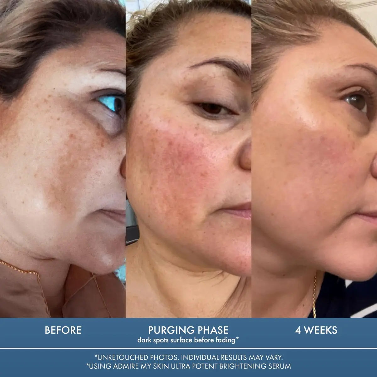 Admire My Skin Dark Spot Corrector Remover for Face - Brightening Discoloration Correcting Serum with Kojic Acid and Azelaic Acid for Melasma and Sun Spots 1oz Avelisse