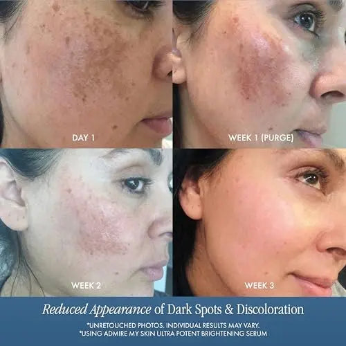 Admire My Skin Dark Spot Corrector Remover for Face - Brightening Discoloration Correcting Serum with Kojic Acid and Azelaic Acid for Melasma and Sun Spots 1oz Avelisse