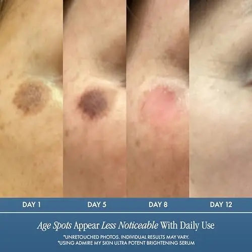 Admire My Skin Dark Spot Corrector Remover for Face - Brightening Discoloration Correcting Serum with Kojic Acid and Azelaic Acid for Melasma and Sun Spots 1oz Avelisse