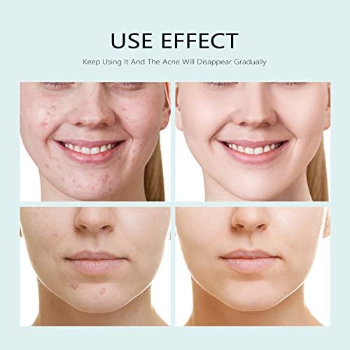 YAFUSIPE Acne Facial Mask with Salicylic Acid - 10 Sheets, Hydrating Moisturizing Sheet Mask for Acne Prone Skin, Oil Control, Redness, Scar & Breakout Care - görsel 4