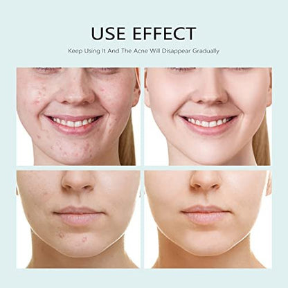 YAFUSIPE Acne Facial Mask with Salicylic Acid - 10 Sheets, Hydrating Moisturizing Sheet Mask for Acne Prone Skin, Oil Control, Redness, Scar & Breakout Care