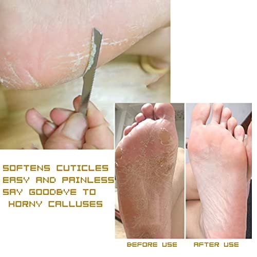 3-Piece Stainless Steel Ingrown Toenail Pedicure Knife Set - Professional Foot Skin Scraper & Callus Repair Blade Kit for Nail Corn Paronychia Treatment Avelisse