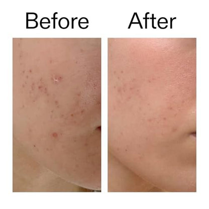 The INKEY List Mandelic Acid Treatment – Fade Hyperpigmentation & Acne Marks, Fragrance-Free Serum for All Skin Types Avelisse