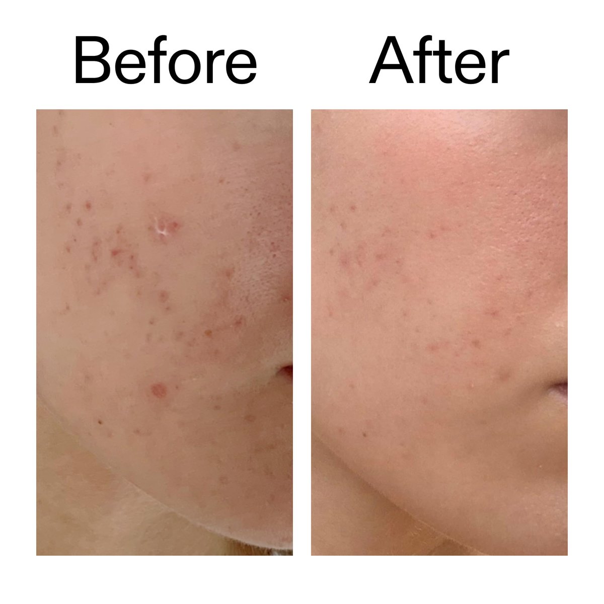 The INKEY List Mandelic Acid Treatment – Fade Hyperpigmentation & Acne Marks, Fragrance-Free Serum for All Skin Types Avelisse