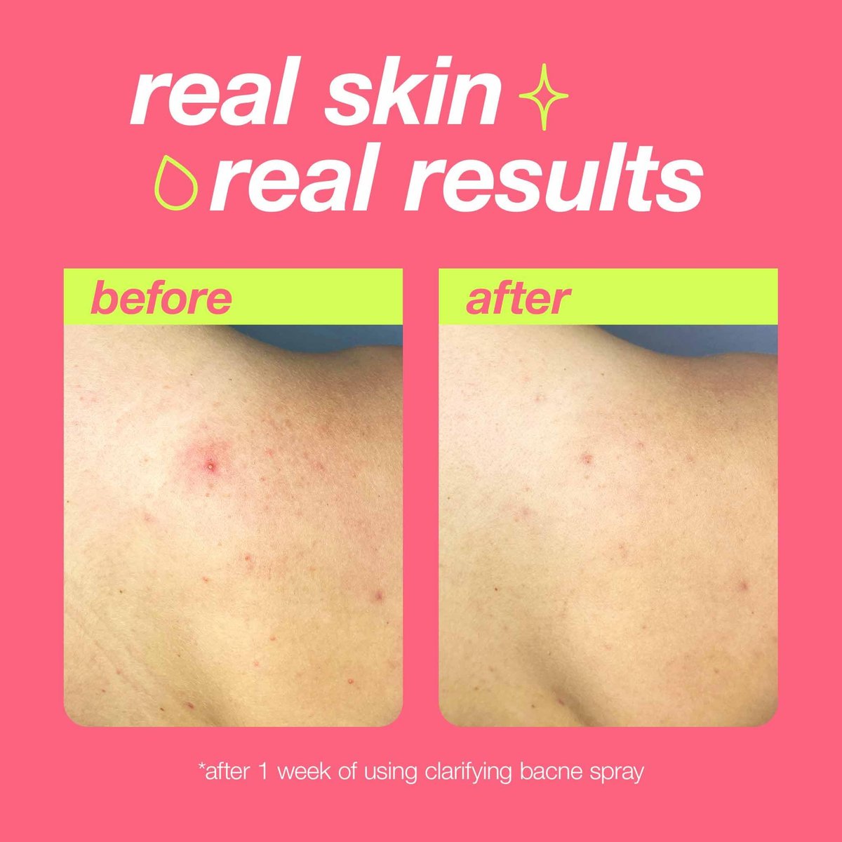Dermalogica Clear Start Clarifying Bacne Spray - Back Acne Treatment with Salicylic Acid, Witch Hazel, Tea Tree Oil, 6 fl oz Avelisse