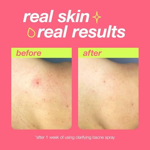 Dermalogica Clear Start Clarifying Bacne Spray - Back Acne Treatment with Salicylic Acid, Witch Hazel, Tea Tree Oil, 6 fl oz Avelisse