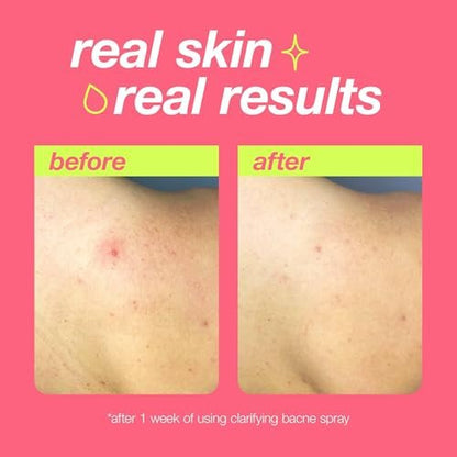 Dermalogica Clear Start Clarifying Bacne Spray - Back Acne Treatment with Salicylic Acid, Witch Hazel, Tea Tree Oil, 6 fl oz Avelisse