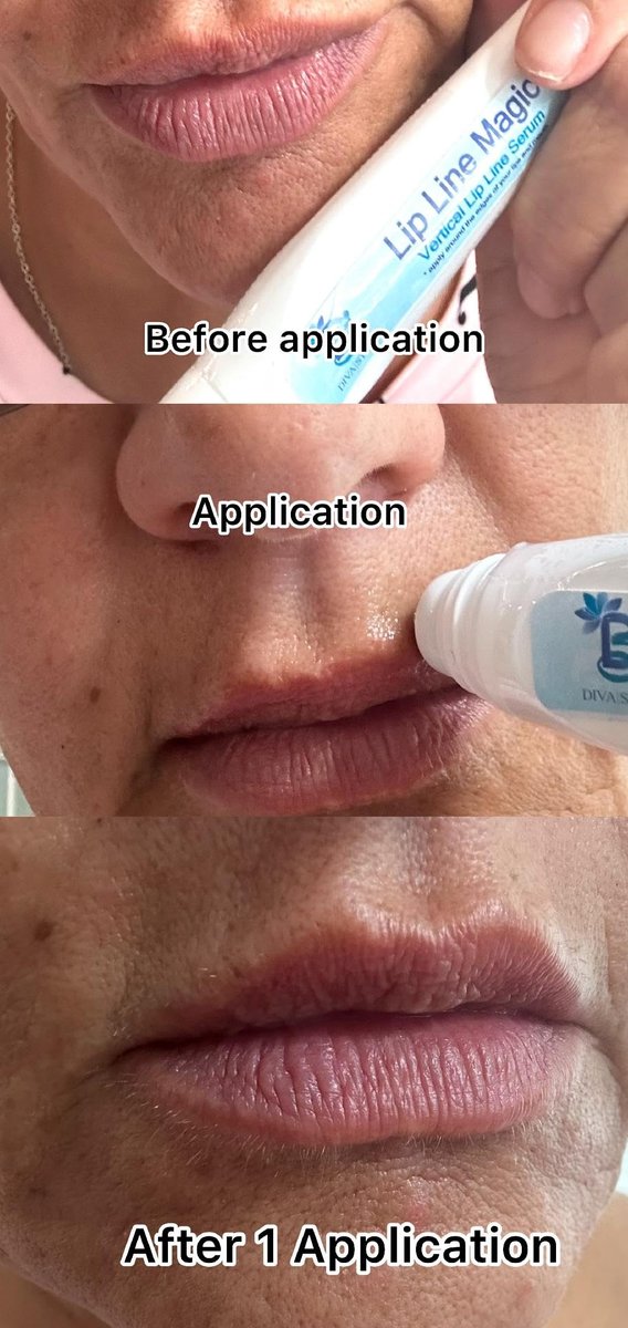 Lip Line Serum For Lines Above the Lips, Max Strength, With Hyaluronic Acid, Papaya Extract and Retinol Avelisse