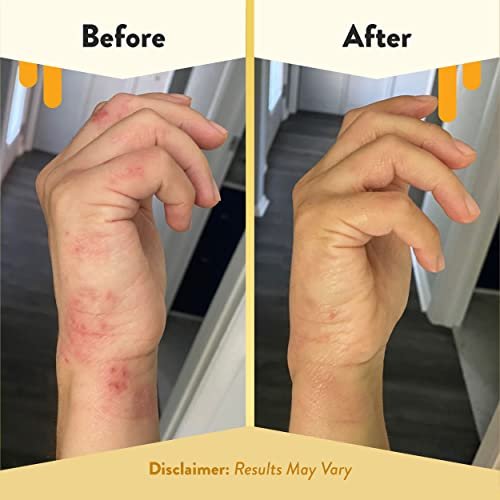 ECZEMA HONEY Antioxidant Body Oil - After Shower All Over Body Oil Spray for Skin - Eczema-Prone & Sensitive Moisturizing Skin Oil - Unscented Body Oils for Women, Men & Kids (8 Fl Oz) Avelisse