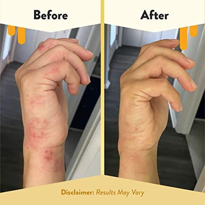 ECZEMA HONEY Antioxidant Body Oil - After Shower All Over Body Oil Spray for Skin - Eczema-Prone & Sensitive Moisturizing Skin Oil - Unscented Body Oils for Women, Men & Kids (8 Fl Oz) Avelisse