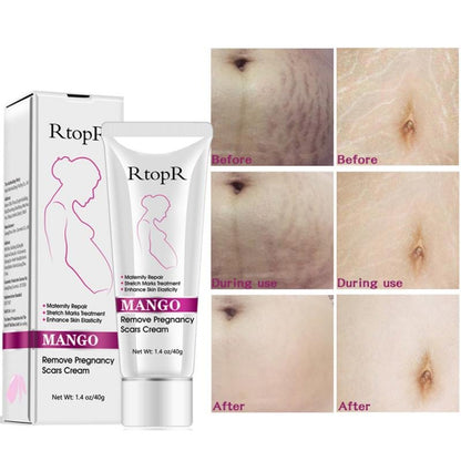 Mango Stretch Marks and Scar Cream - Effective Removal for Pregnancy, Wrinkles, Obesity Marks - Moisturizing Belly Cream (40g)