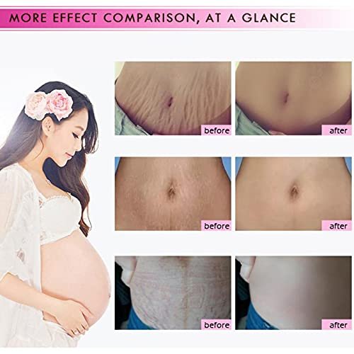 Mango Stretch Marks and Scar Cream - Effective Removal for Pregnancy, Wrinkles, Obesity Marks - Moisturizing Belly Cream (40g) - görsel 9