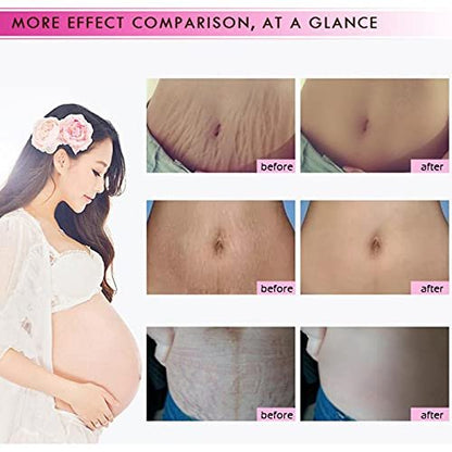 Mango Stretch Marks and Scar Cream - Effective Removal for Pregnancy, Wrinkles, Obesity Marks - Moisturizing Belly Cream (40g)