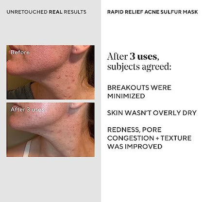 Murad Rapid Relief Acne Sulfur Mask – 2.5 oz Clay Mask with Salicylic Acid, 5% Sulfur & Austrian Peat to Reduce Oil, Minimize Breakouts & Unclog Pores Avelisse