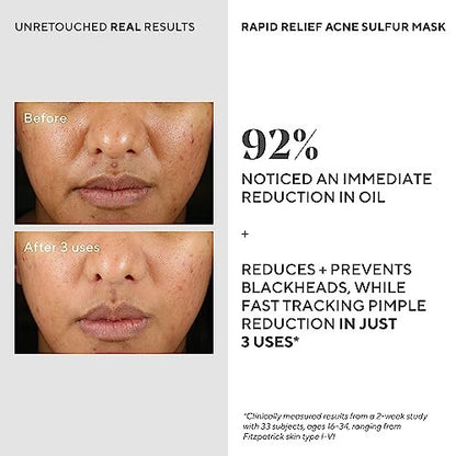 Murad Rapid Relief Acne Sulfur Mask – 2.5 oz Clay Mask with Salicylic Acid, 5% Sulfur & Austrian Peat to Reduce Oil, Minimize Breakouts & Unclog Pores Avelisse